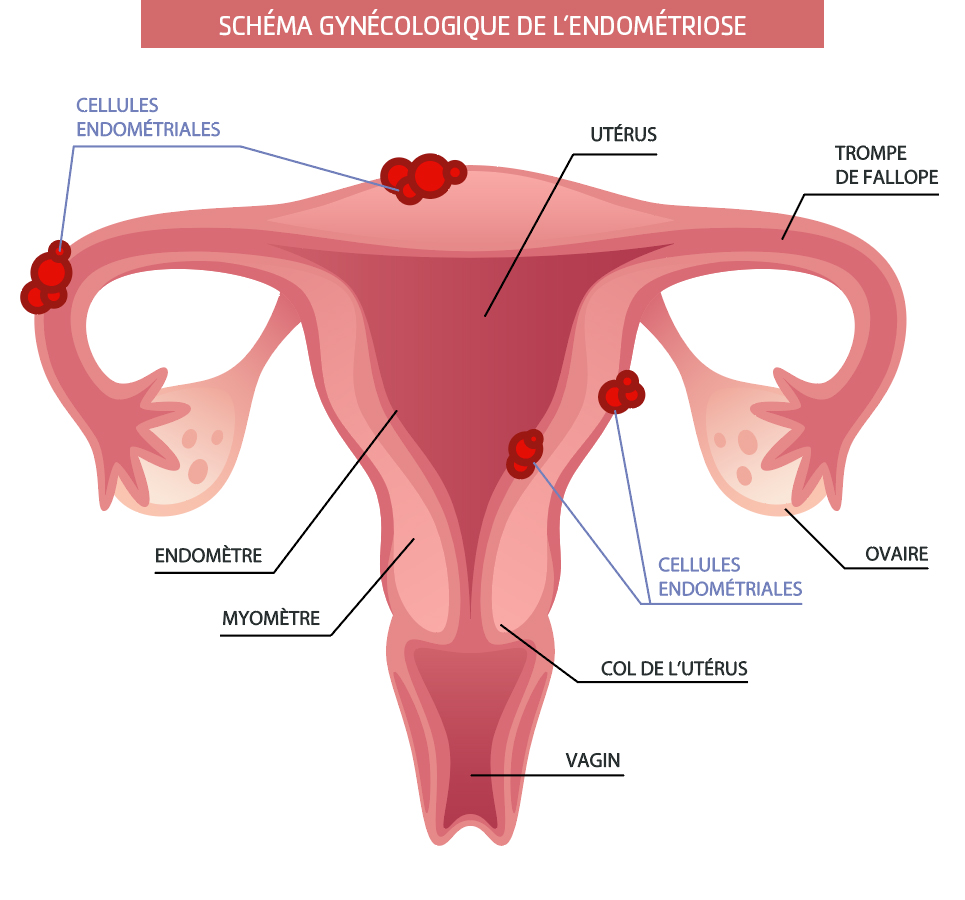 Schéma gynécologique de l'Endométriose
